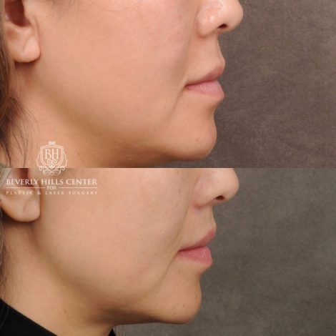 Beverly Hills Center Female Patient Before and After CUPID LIFT® Corner Lift