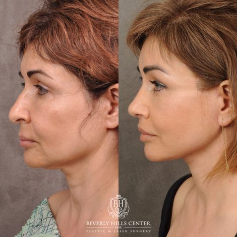 Beverly Hills Center Female Patient Before and After Comprehensive AuraLyft, Brow Lift, Rhinoplasty, CUPID LIFT® Corner Lift, Ptosis Repair