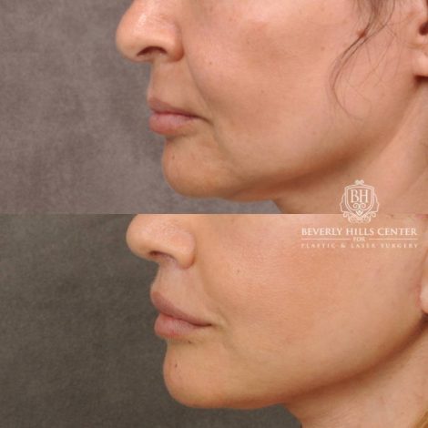 Beverly Hills Center Female Patient Before and After Natural Rhinoplasty and Deep Plane Modified Upper Lip Lift