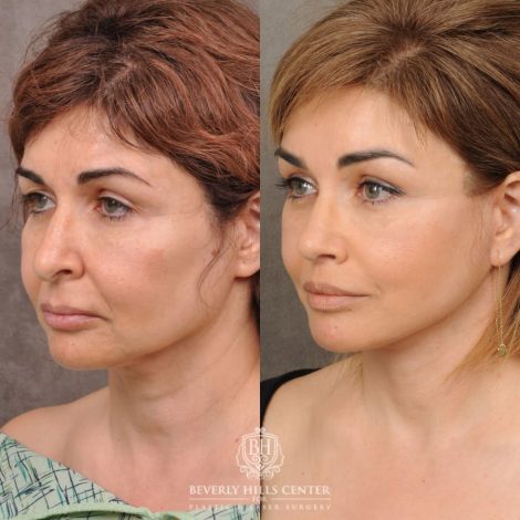 Beverly Hills Center Female Patient Before and After Comprehensive AuraLyft, Brow Lift, Rhinoplasty, CUPID LIFT® Corner Lift, Ptosis Repair