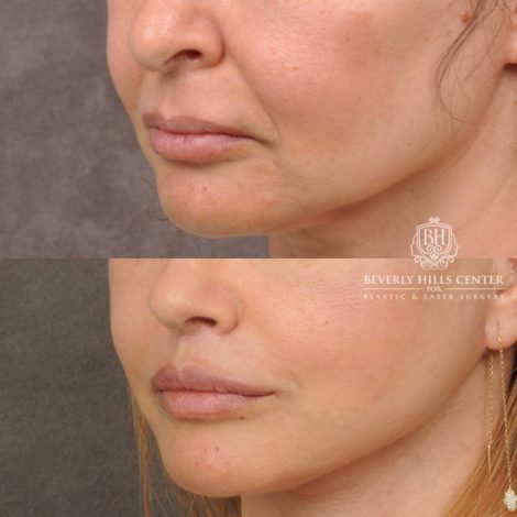 Beverly Hills Center Female Patient Before and After Natural Rhinoplasty and Deep Plane Modified Upper Lip Lift