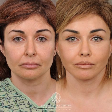 Beverly Hills Center Female Patient Before and After Comprehensive AuraLyft, Brow Lift, Rhinoplasty, CUPID LIFT® Corner Lift, Ptosis Repair