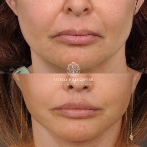 Beverly Hills Center Female Patient Before and After Natural Rhinoplasty and Deep Plane Modified Upper Lip Lift