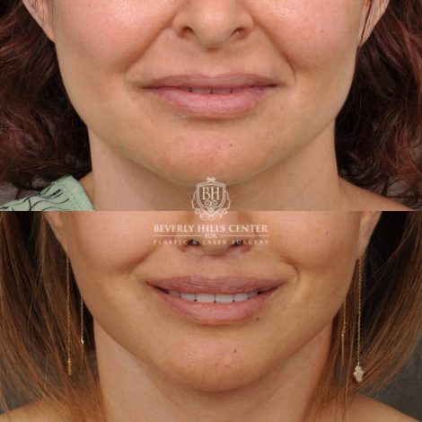 Beverly Hills Center Female Patient Before and After Natural Rhinoplasty and Deep Plane Modified Upper Lip Lift