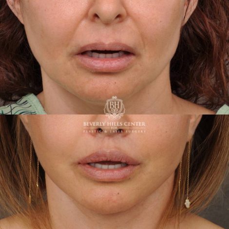Beverly Hills Center Female Patient Before and After Natural Rhinoplasty and Deep Plane Modified Upper Lip Lift