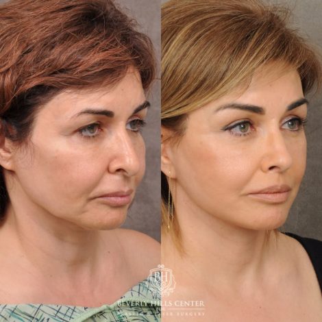 Beverly Hills Center Female Patient Before and After Comprehensive AuraLyft, Brow Lift, Rhinoplasty, CUPID LIFT® Corner Lift, Ptosis Repair