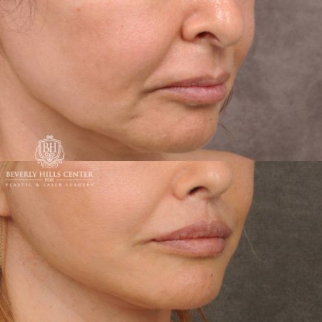 Beverly Hills Center Female Patient Before and After Natural Rhinoplasty and Deep Plane Modified Upper Lip Lift