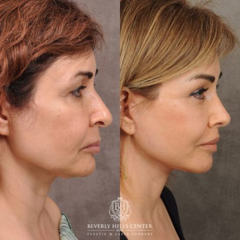Beverly Hills Center Female Patient Before and After Comprehensive AuraLyft, Brow Lift, Rhinoplasty, CUPID LIFT® Corner Lift, Ptosis Repair