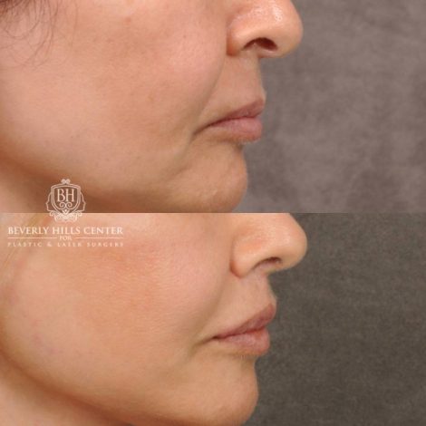 Beverly Hills Center Female Patient Before and After Natural Rhinoplasty and Deep Plane Modified Upper Lip Lift
