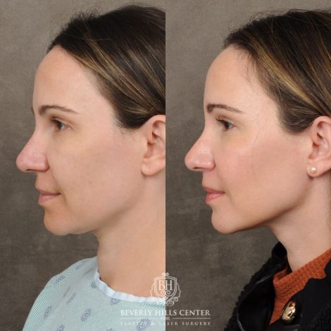 Beverly Hills Center Female Patient Before and After Lip Lift, Brow Lift, Upper Blepharoplasty, and Profound