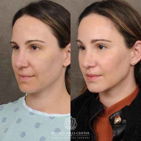 Beverly Hills Center Female Patient Before and After Lip Lift, Brow Lift, Upper Blepharoplasty, and Profound