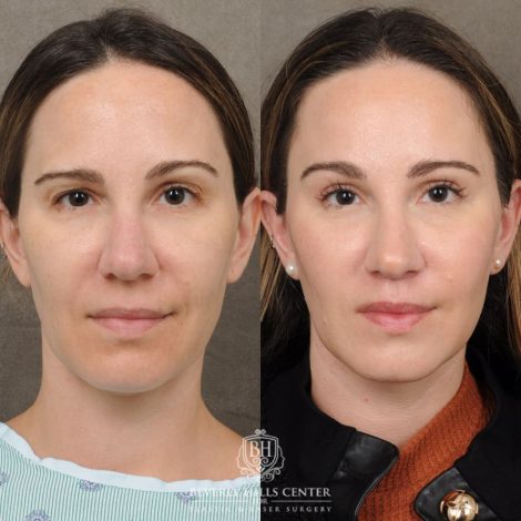 Beverly Hills Center Female Patient Before and After Lip Lift, Brow Lift, Upper Blepharoplasty, and Profound