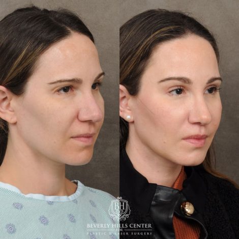 Beverly Hills Center Female Patient Before and After Lip Lift, Brow Lift, Upper Blepharoplasty, and Profound