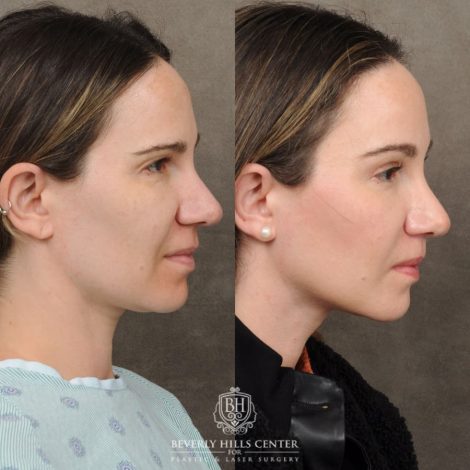 Beverly Hills Center Female Patient Before and After Lip Lift, Brow Lift, Upper Blepharoplasty, and Profound