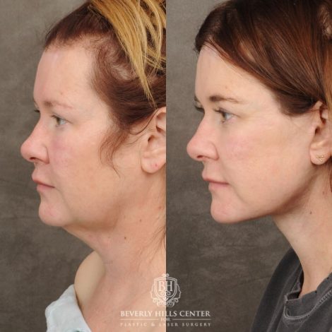 Beverly Hills Center Female Patient Before and After AuraLyft, CUPID LIFT® Corner Lift