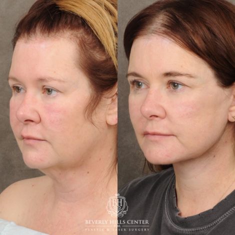 Beverly Hills Center Female Patient Before and After AuraLyft, CUPID LIFT® Corner Lift