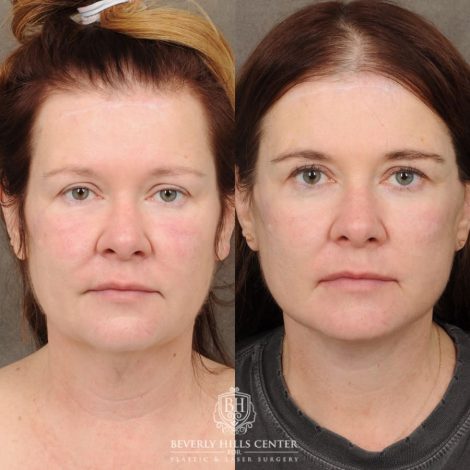 Beverly Hills Center Female Patient Before and After AuraLyft, CUPID LIFT® Corner Lift