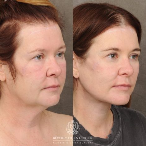 Beverly Hills Center Female Patient Before and After AuraLyft, CUPID LIFT® Corner Lift