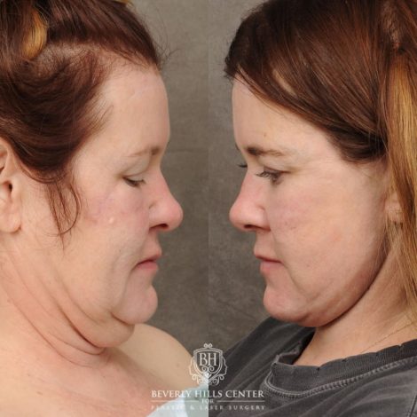 Beverly Hills Center Female Patient Before and After AuraLyft, CUPID LIFT® Corner Lift