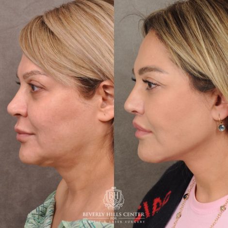 Beverly Hills Center Female Patient Before and After AuraLyft, Brow Lift, Lip Lift, Rhinoplasty