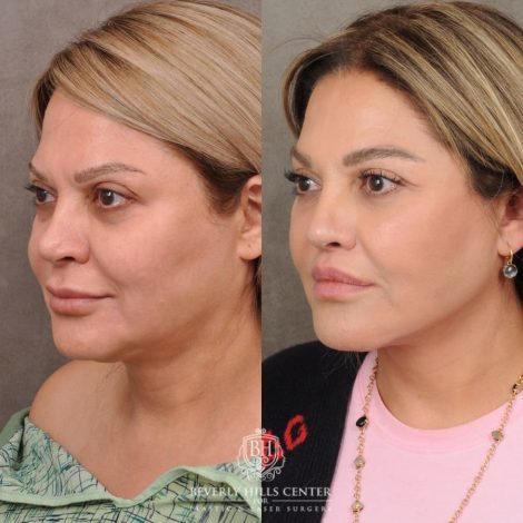 Beverly Hills Center Female Patient Before and After AuraLyft, Brow Lift, Lip Lift, Rhinoplasty