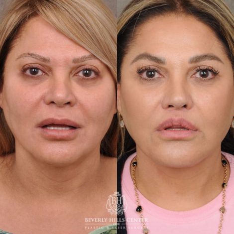 Beverly Hills Center Female Patient Before and After AuraLyft, Brow Lift, Lip Lift, Rhinoplasty