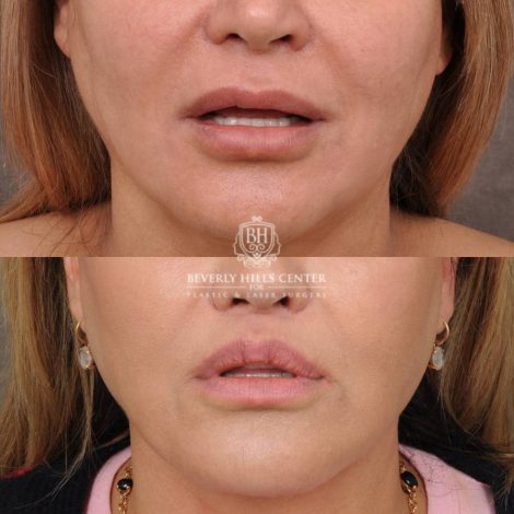 Beverly Hills Center Female Patient Before and After AuraLyft, Brow Lift, Lip Lift, Rhinoplasty