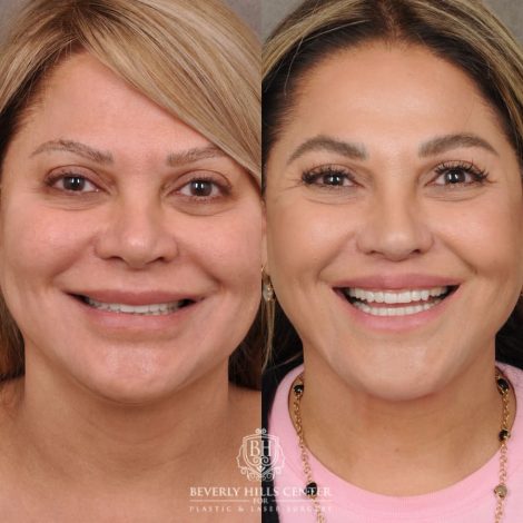 Beverly Hills Center Female Patient Before and After AuraLyft, Brow Lift, Lip Lift, Rhinoplasty