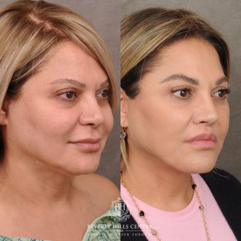 Beverly Hills Center Female Patient Before and After AuraLyft, Brow Lift, Lip Lift, Rhinoplasty
