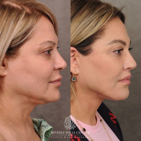 Beverly Hills Center Female Patient Before and After AuraLyft, Brow Lift, Lip Lift, Rhinoplasty