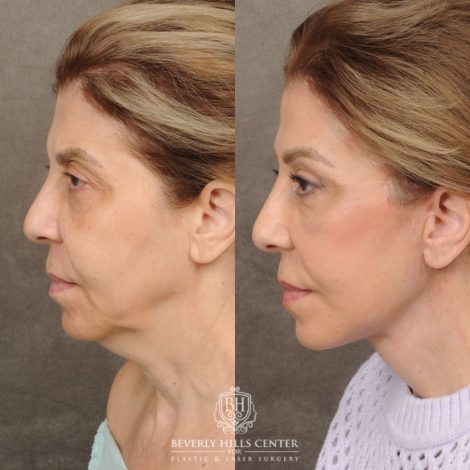 Beverly Hills Center Female Patient Before and After AuraLyft, Brow Lift, Upper Blepharoplasty & Ptosis Repair