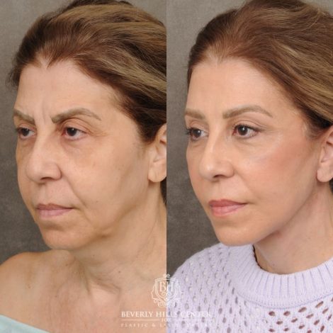 Beverly Hills Center Female Patient Before and After AuraLyft, Brow Lift, Upper Blepharoplasty & Ptosis Repair