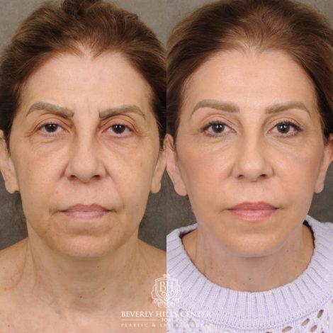 Beverly Hills Center Female Patient Before and After AuraLyft, Brow Lift, Upper Blepharoplasty & Ptosis Repair