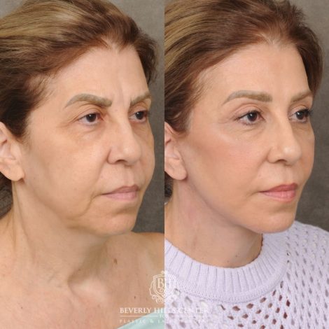 Beverly Hills Center Female Patient Before and After AuraLyft, Brow Lift, Upper Blepharoplasty & Ptosis Repair