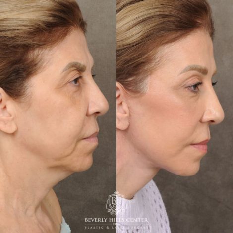 Beverly Hills Center Female Patient Before and After AuraLyft, Brow Lift, Upper Blepharoplasty & Ptosis Repair
