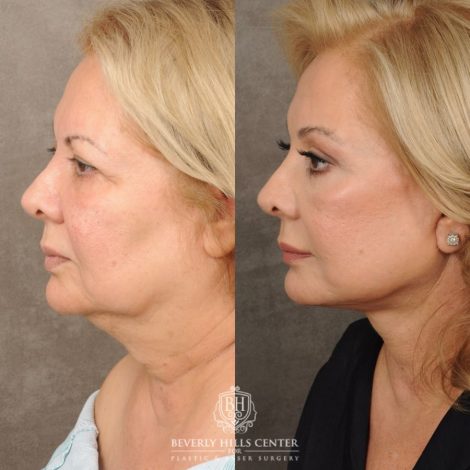Beverly Hills Center Female Patient Before and After Comprehensive AuraLyft, Brow Lift, CUPID LIFT® Corner Lift Type 2, Upper & Lower Blepharoplasty