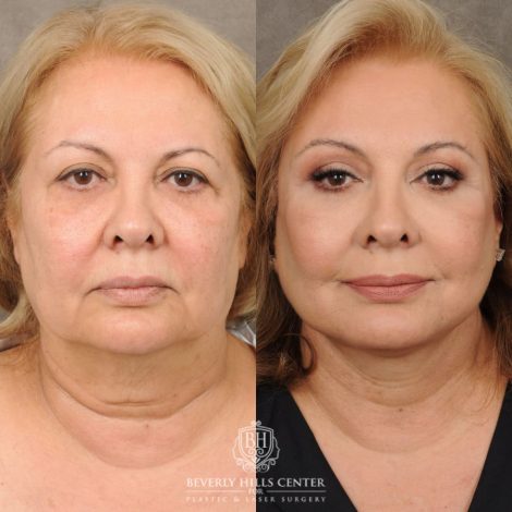 Beverly Hills Center Female Patient Before and After Comprehensive AuraLyft, Brow Lift, CUPID LIFT® Corner Lift Type 2, Upper & Lower Blepharoplasty