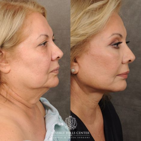 Beverly Hills Center Female Patient Before and After Comprehensive AuraLyft, Brow Lift, CUPID LIFT® Corner Lift Type 2, Upper & Lower Blepharoplasty