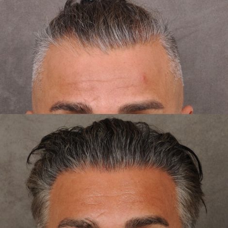 male patient before and after a combination of a FUE hair transplant and PRP treatment