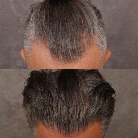 male patient before and after a combination of a FUE hair transplant and PRP treatment