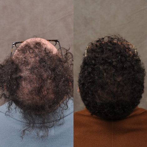 male patient before and after a combination of a FUE hair transplant and PRP treatment