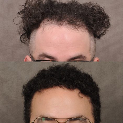 male patient before and after a combination of a FUE hair transplant and PRP treatment