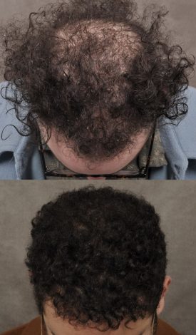 male patient before and after a combination of a FUE hair transplant and PRP treatment