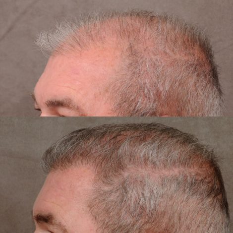 male patient before and after a combination of a FUE hair transplant and PRP treatment