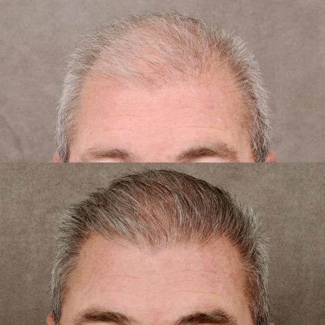male patient before and after a combination of a FUE hair transplant and PRP treatment