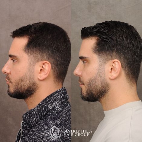 patient before and after hair procedure