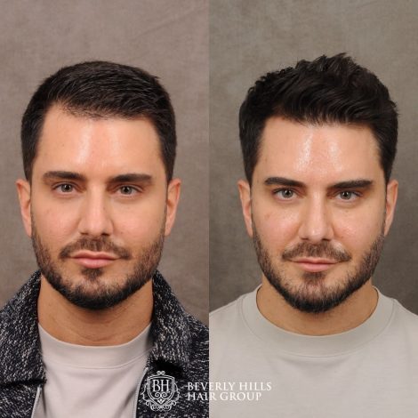 patient before and after hair procedure