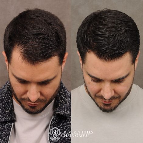 patient before and after hair procedure