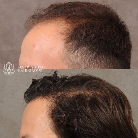 male patient before and after a combination of a FUE hair transplant and PRP treatment