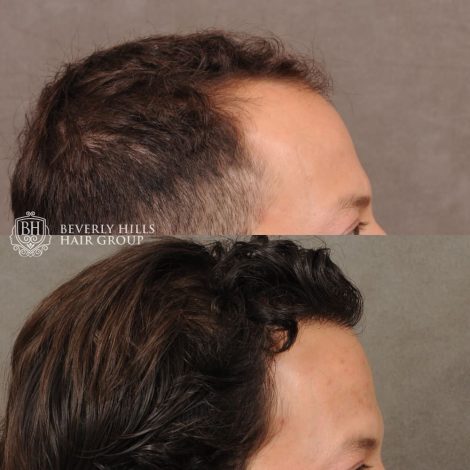 male patient before and after a combination of a FUE hair transplant and PRP treatment
